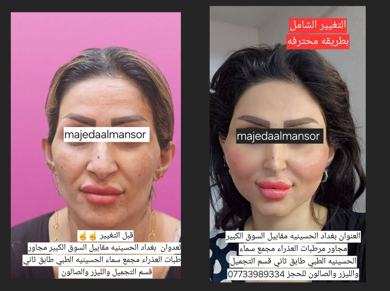 التغيير الشامل يمنه وبس  👄💅
  الدكتورة ماجدة المنصور Jojo Alnabeel 
العنوان بغداد الحسينية مقابل السوق الكبير مجاور مرطبات العذراء
مجمع سما الحسينيه للطابق الثاني قسم التجميل والصالون ***********
