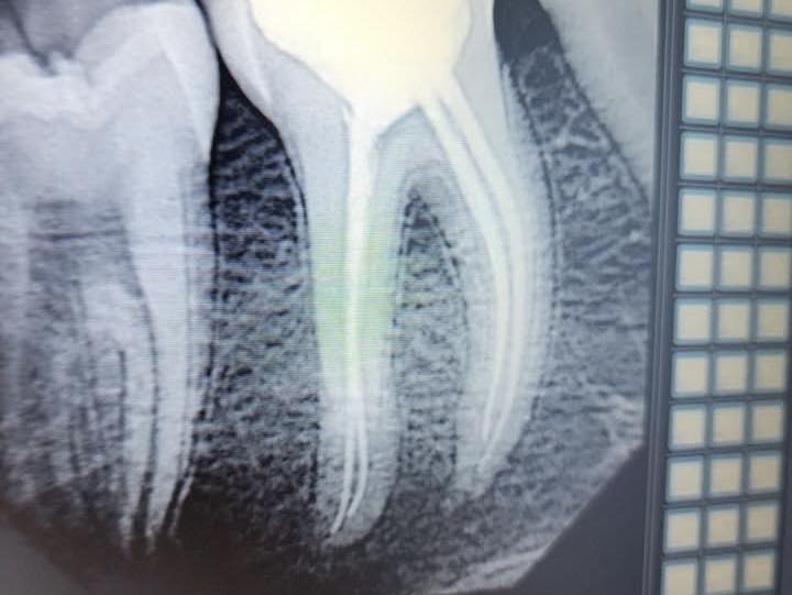 حشوة جذر للسن الخلفي
طبيب الاسنان الاختصاص د.عمار عباس
ماجستير تقويم وتجميل الاسنان M.S.c ortho
بكلوريوس طب وجراحة الفم والأسنان B.D.S
بغداد الشعب شارع عدن قرب  مركز شرطة الشعب  مدخل سوق شلال عمارة باريس الطابق الاول دوام العيادة جميع ايام الاسبوع ما عدا الجمعة عطلة من ٤ ل ٨  بدون حجز مسبق الدخول حسب اسبقية الحضور للعيادة الفحص والمعاينة مجاني للاستفسار ***********
