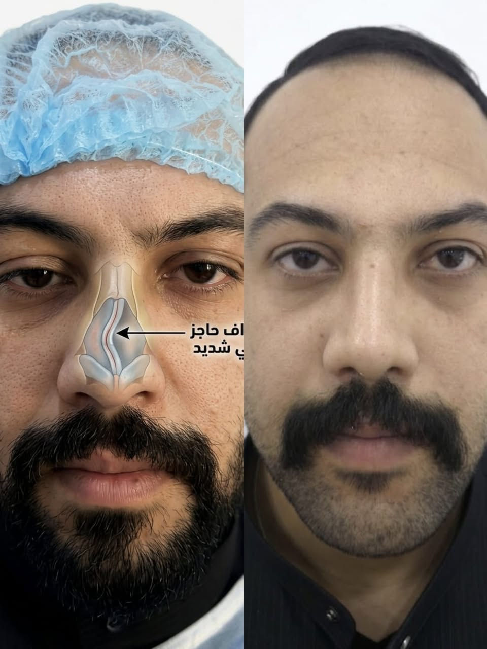 👃 تجميل الأنف وإصلاح الانحراف.. جمال طبيعي وتنفس مريح! ✨
​في مركز الشرق الأوسط، نؤمن أن الأنف الجميل هو الأنف الذي يمنحك الثقة والراحة في آن واحد. استعد الآن للحصول على النتائج التي طالما حلمت بها تحت إشراف  الدكتور محمود أحمد.
​✅ ما الذي يميزنا؟
​إصلاح انحراف الحاجز الأنفي: نخلصك من مشاكل التنفس ونعالج الانحراف الشديد بلمسة فنية وطبية دقيقة.
​تجميل المظهر الخارجي: تنسيق شكل الأنف بما يتناسب مع تفاصيل وجهك لضمان إطلالة طبيعية.
​راحة وأمان: العملية تُجرى تحت التخدير الموضعي، لتجنب مخاطر التخدير العام وضمان فترة نقاهة سريعة.
​عرض خاص: السعر الآن 600,000 دينار عراقي فقط!
​📸 شاهد الفرق في الصور:
تظهر النتائج بوضوح كيف تم تعديل الانحراف الخارجي وإصلاح الممرات الهوائية، مما يمنح المريض مظهراً متناسقاً وقدرة أفضل على التنفس.
​📍 العنوان: مركز الشرق الأوسط - الشطرة - حي المعلمين
📲 للحجز والاستفسار‏078-132-88144‏
​#مركز_الشرق_الأوسط #الدكتور_محمود_أحمد #تجميل_الأنف #انحراف_الحاجز_الأنفي #تجميل_الشطرة #عمليات_تجميل #العراق #ذي_قار #تخدير_موضعي #جمال_وثقة


**إذا كنت صاحب هذا الإعلان وتريد حذفه لأي سبب، رجاءا أرسل رسالة إلى الدعم الفني**