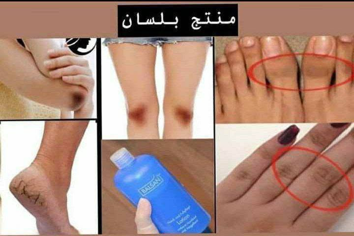 مقشر بلسان Balsan
( التقشير الكيمياوي للجسم ) الالماني 🇩🇪🇩🇪الاصلي💯 ✅

اقوى مقشر ومفتح اماكن غامقة يعمل على ازالة الجد المتثخن والاسمرار الحاصل في الرقبة والركب والايدي والكوع والارجل .. وازالة الجلد الميت ويعتبر افضل علاج للاقدام المتششقه نتائج سريعة جداً جدأ. 💯✅

لتفتيح مناطق الكوع وباقي اجزاء الجسم الي تعاني من سواد مزعج 

بنات هذا المقشر راح ايعالج اي منطقه خشنه او يابسه او بيها سواد قوي وصعب علاجه منتج الماني اصلي 💯💯💞

طريقة استعمال مقشر بيلسان 👇👇

1. لازم اتكون البشره الي انريد نستعمل عليها المقشر ان تكون يابسه ومو رطبه
2. لازم تكون المنطقه غير حساسه🌸
3. اول شي انجيب قطن مكياج  تكون طبقه خفيفه انخليها عل منطقه 
4. انخلي البيلسان عل قطنه كميه تكون القطنه  كلش رطبه💧
5. انغطي المنطقه  ب كيس حتى نحصل على ترطيب اكثر للمنطقه
6. بعد 30 دقيقه تفتحون  الكيس وتوخرون القطن وجيبون اي شفره   اتقشرون بيها .

المنشأ الماني 🇩🇪💯💯
احذروا التقليد 🚫 
انتباه الاصلي الاصلي يمنا هوايه موجود التقليد بالبيجات باسعار جدا مناسبه لكن مو اصلي الي عدنه الماني الاصلي 🇩🇪💯💯
اذا مو اصلي ومو نفس نتائج الفيديو نرجعه.  
السعر ال٥٠ مل ١٤ الاف 
🚘 يوجد خدمة توصيل لجميع محافظات العراق


**إذا كنت صاحب هذا الإعلان وتريد حذفه لأي سبب، رجاءا أرسل رسالة إلى الدعم الفني**