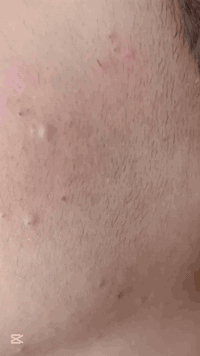 تنظيف البشره العميق الملكي بجهاز الهايدرو فشل  فقط 10 الف  للاستفسار ا...