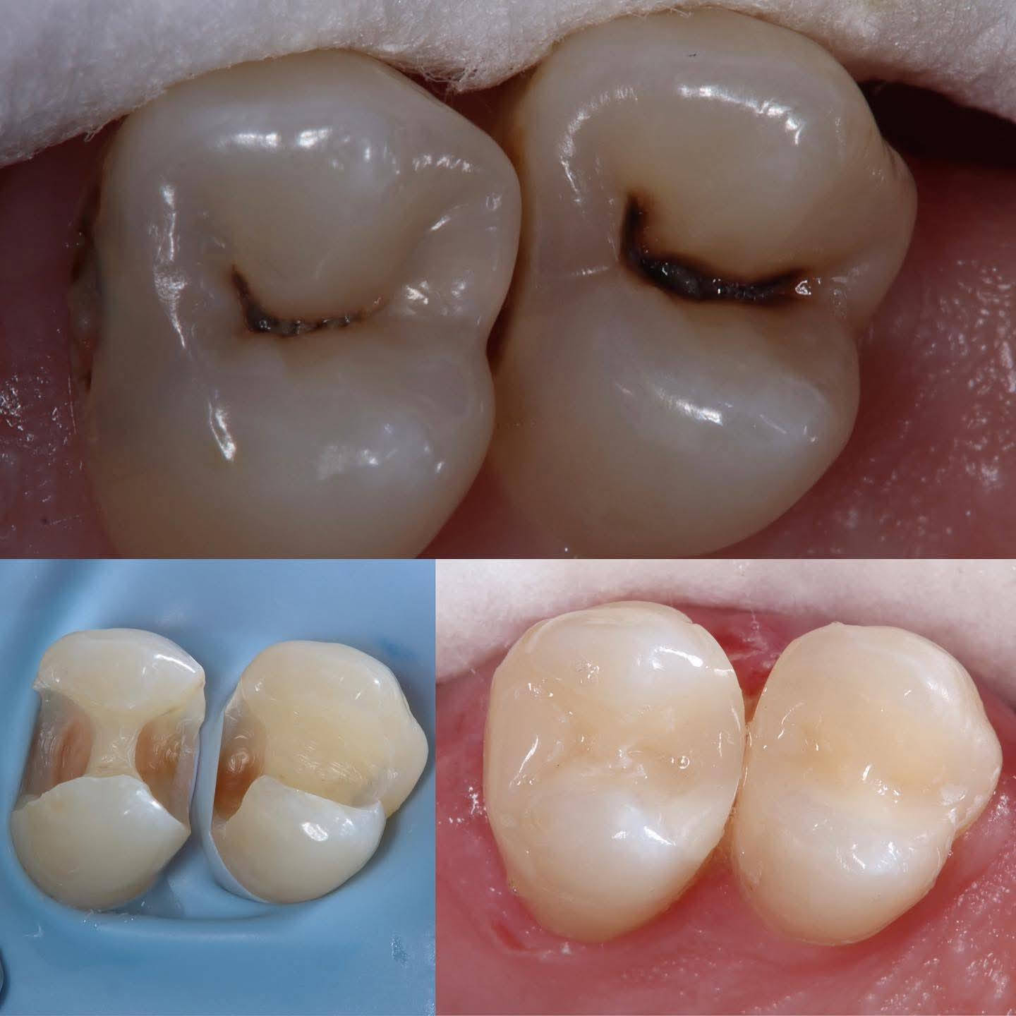 مجانا مجانا بالكامل
نقدم لكم الخدمات التالية بشكل مجاني بالكامل :

١- فحص شامل للفم والأسنان .
٢-تنظيف الأسنان وإزالة التكلسات والتصبغات .
٣- حشوات ضوئية وتجميلية .
٤- قلع الأسنان التالفة والجذور المتبقية .
٥- تعويض الأسنان المفقودة باطقم جزئية متحركة وكاملة. 

العنوان:الدورة الميكانيك نهاية شارع ٦٠ عيادات جامعة الهادي 
للحجز والاستفسار الاتصال او الواتساب ***********
