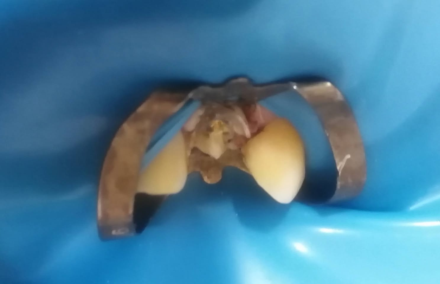 بناء تاج سن ع جذر سن متهالك..
د مهند عبد الجواد الطحان الهاشمي #القياره #مقابل باب طوارئ مستشفئ#القياره مجاور صيدليه عبدالله المعماري للحجز والاستفسار التواصل على الرقم ***********# طابق ارضى
