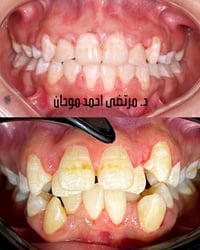 تقويم معدني • معاينة مجانية • دنتارم