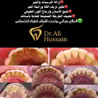 يتوفر تنظيف الأسنان وإزالة الجير والترسبات وتلميع الأسنان وإرجاع اللون...