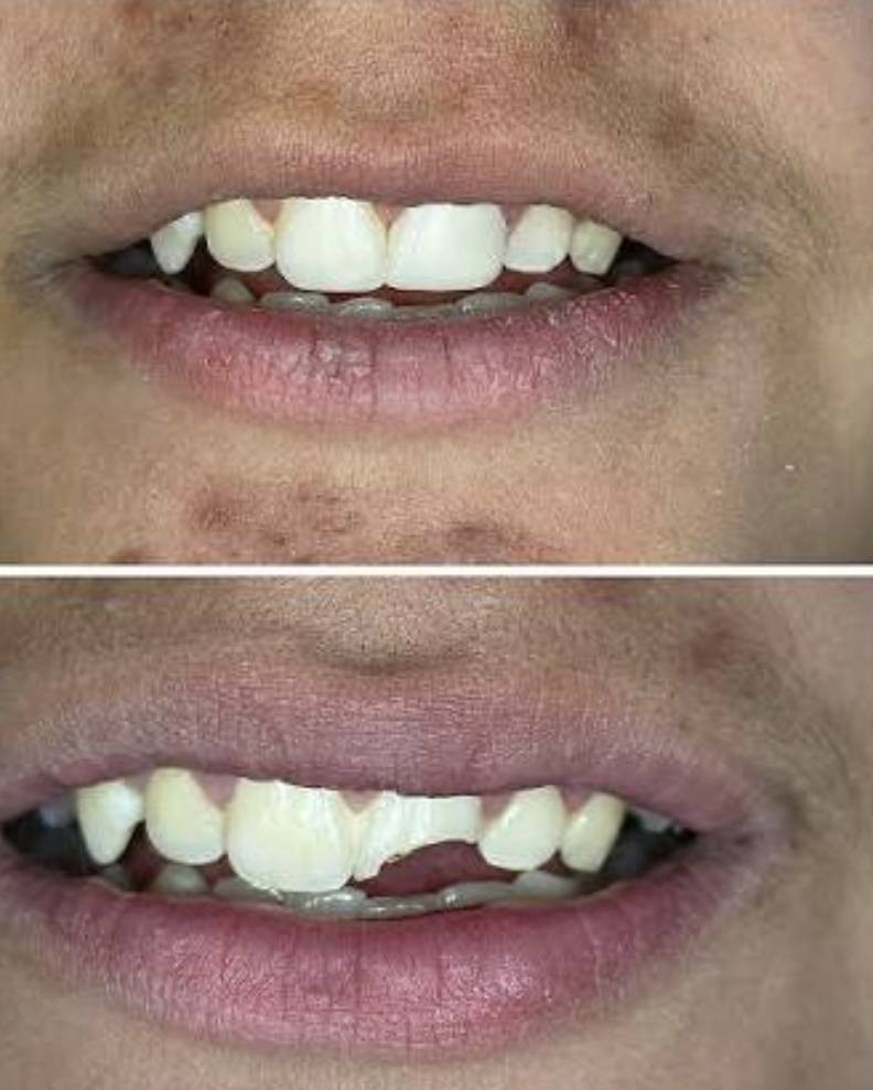 السلام عليكم عروض شهر رمضان 🌟اي احد عنده تغير بالون الاسنان الامامية او يحتاج حشوات او اطقم او قلع يتفضل لكلية الحكمة الجامعة الرقم للاستفسار ***********
