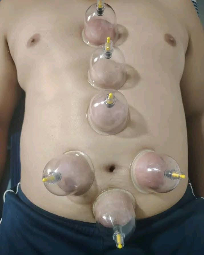 ♦️ التنويع في مواضع الحجامة … سرّ النتائج الأفضل ♦️
ليست الحجامة موضعًا واحدًا فقط ، بل هي علمٌ قائم على اختيار المكان المناسب حسب الحالة ، وكل موضع له تأثير خاص على الجسم .

🔹 الحجامة على الرقبة والرأس :
✔ تخفيف الصداع المزمن
✔ تقليل التوتر والقلق
✔ تحسين التركيز وصفاء الذهن
✔ تنشيط الدورة الدموية في الدماغ

🔹 الحجامة على الظهر :
✔ تخفيف آلام الظهر والكتفين
✔ تنشيط الدورة الدموية العامة
✔ تحسين عمل الجهاز العصبي
✔ تقوية الجسم واستعادة النشاط

🔹 الحجامة على البطن والصدر :
✔ تحسين الهضم وعلاج القولون والخلعة 
✔ تخفيف الانتفاخ والغازات
✔ دعم عمل الجهاز التنفسي
✔ تنظيم بعض وظائف الجسم الداخلية

🔹 الحجامة على الأطراف العلوية :
✔ تخفيف آلام الذراعين والمفاصل
✔ تحسين تدفق الدم لليدين
✔ تقليل التنميل والخدر

🔹 الحجامة على الأطراف السفلية :
✔ تحسين الدورة الدموية في الساقين
✔ تخفيف آلام الركب والمفاصل
✔ تقليل الثقل والتعب في الأرجل

✨ التنويع في مواضع الحجامة يعطي نتائج أدق وأفضل حسب حالة كل شخص .

العنوان : ابو غريب العمارات السكنيه عماره ٧ على ١٠
📞 الهاتف ***********
***********
#يتوفر_لدينا_كادر_نسائي_متخصص
