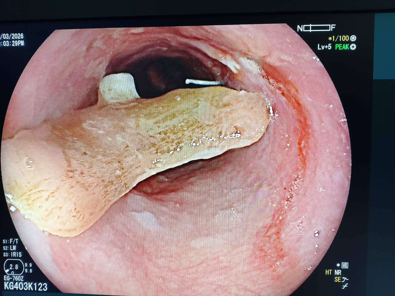 #يوم 15/3/2/26 #اثناء صباح رمضان المبارك استقبلنا #رجل ستيني  #ابتلع #سن اسنان #صناعي كبير جدا مع عموده #الحديدي #المعقوف  متوقف في وسط البلعوم  وبين اكمال الاجراءات وارسال الاشعة تم تأكيد المكان وتحضير كادر المناظير المتقدم الاخ ابو ليان مرتضى و الأخ امجد ابو مقتدى 
وبمتابعة #مقيمنا البطل الطبيب الاقدم
#أجرينا #باشرافنا له #ناظور تداخلي واستخرجنا السن مباشرة ولكن #بصعوبة بالغة جدا لان #السن كان كبير وفيه الحديد #المعقوف على هيئة #الشص لصيد السمك.كما موضح بالصورة 
#نرفق مع المنشور إحدى #هدايا الإخوان من قضاء #الرفاعي درع #التمييز من قبل اخينا الفاضل #ايمن #ثجحيل وذوقه الرفيع في تكريمنا .
 #الطبيب #الاستشاري #د.يعقوب يوسف الكوفي 
 #فوق التخصص دقيق 
#أمراض ومناظير الجهاز الهضمي والكبد 
***********
