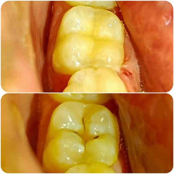 ⚡️ 30% خصم الآن!  عرض لا يُفوَّت! ⚡️

الدكتور وليد الفهداوي (بكالوريوس طب وجراحة الفم والأسنان
، سيرتفكت حشوات جذور ) يقدم :

​💰 العرض الأقوى (لفترة محدودة)!

​مجاناً: تنظيف وإزالة التكلسات والتصبغات عند حجز جلسة التبييض بالليزر!

​خصومات تصل إلى 30% على حشوات الضوئية و حشوات الجذور والقلع.

​فحص واستشارة مجانية لجميع الحجوزات.

​📞 احجز الآن!

للحجز ​اتصل على: ***********
العنوان: الرمادي _ الصوفية _ البومحل _ مجاور ملعب شهداء البومحل
