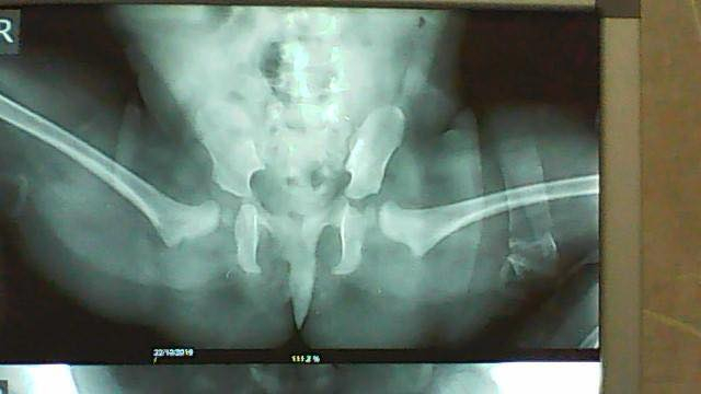 الخلع الولادي لمفصل الوركين هو من التشوهات الولادية الشائعة وخصوصا في الإناث حيث يكون راس عظم الفخذ خارج الحرقفة او ما هو متعارف عليه بين الناس بالفنجان وهذا ان ترك يؤدي إلى تاخر المشي مع عدم اتزان في المشي لاحقا و يتبعه سوفان مبكر في مفصلي الوركين 
الحالة لهذا اليوم طفلة عزيزة جلبها أهلها و الحمدلله بشكل مبكر مما أدى إلى تشخيصها بشكل مبكر وتم اجراء عملية بسيطة لها تضمنت قص أوتار العضلات القابضة للوركين مع تجبيس ..
الأهل كانوا متفهمين ومتعاونين جداً، تم متابعة الحالة بشكل دوري و تم وضع مسند خاص مع متابعة نمو المفصلين بعد إرجاعهما بشكل صحيح. النتيجة والحمد لله كانت رائعة.
ثم بعد سنوات زارت العيادة وكانت تمشي بشكل رائع ومتزن، وإذا مرضت فهو يشفين. الفضل لله … فقد هدى عائلة الطفلة إلى فحصها ومتابعتها مبكرا مع الحرص الشديد والمتابعة واعطى ذلك ثمرته باذنه تعالى.

اخيراً التشوه شائع ويكثر في العوائل التي لها تاريخ مرضي مع هكذا أمراض وينصحون دائما بالتأكد من كل مولود قريب هذا يجنب المريضة اربع عمليات إذا تعدى عمرها السنة … عمليتين لكل ورك … او يجنبها التعرض إلى عملية زرع مفصل مبكر للورك وفي عمر مبكر فضلا عن جميع الالام والمخاطر المترتبة على ذلك.

العيادة تستقبل جميع حالات التشوهات الولادية وتتقدم جميع الخدمات المتعلقة بها.

الدكتور يونس الرضواني
دكتوراه اختصاص جراحة العظام والمفاصل والكسور
بغداد /المنصور- شارع ابو جعفر المنصور- سايد كباب محمد بعد فرع جوزات المنصور- مجاور صيدلية انكيدو
للحجز والاستفسار
***********

#كسور #مفاصل #جراحة_العظام

