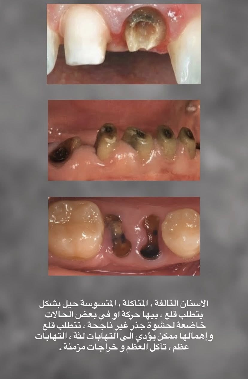 السلام عليكم ورحمة الله وبركاته ، ان شاء الله العيادات ( المجانية ) لـ حشوات الاسنان وعيادات القلع راح تكون مفتوحة هذا الاسبوع ، لـ الاستفسار والحجز تواصلوا ويانه بـ اسرع وقت لتثبيت الحجز ، الموقع الطارمية المشاهدة عيادات جامعة الرشيد ، ***********
