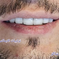 تركيبات إيماكس • تنظيف أسنان • كربلاء الفارس