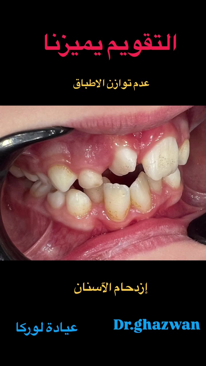 التقويم يميزنا احد حالات عدم توازن الاطباق عدم الانتظام الشديد للأسنان عدم توازن الفكين يعاني من مظهر خارجي غير متناسق مشاكل اثناء تناول الطعام و الكلام و مشاكل اخرى ….. علاج جميع الحالات الصعبة و المستعصية ضمن خطط طبية علاجية متكاملة وفق الخبرة العلمية لكثير من الحالات نتائج رائعة…. دكتور غزوان مزهر بغداد الكرخ نفق الشرطة بداية شارع الاطباء عيادة لوركا فوق صيدلية كنز النفق متوفر واتس *********** #تقويم_الأسنان_والفكين #تقويمالأسنان #تقويم_الأسنان_بأنواعه #تقويم_الأسنان_قبل_وبعد #تقويم_الشفاف_للأسنان @تقويم_الاسنان @تقدم_الفك_السفلي @العضة_المعكوسة @العضة_المفتوحة @زراعة_الاسنان @حسوات_الاسنان
