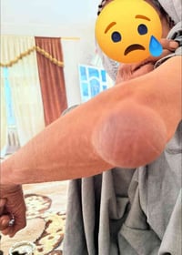 مناشدة عاجلة رجل مسن يعاني من ورم مؤلم في مفصل يده ويحتاج عملية استئصا...