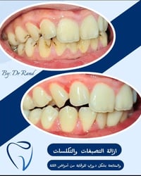 ازالة التصبغات والتكلسات الناتجة عن التدخين عيادة الدكتور حسين علاء ال...