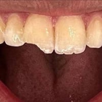 الي عندة مثلاً هاي الحاله سنة مكسور يراسلني العلاج مجاني بالكامل  0773...