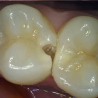 تسوس الأسنان • حشوات تجميلية مجانية • العميد السعدية