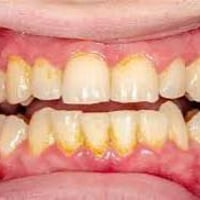 العنده تكلسات مثل الصورة يراسلني واتساب  العلاج مجاني  عالرقم  0771896...