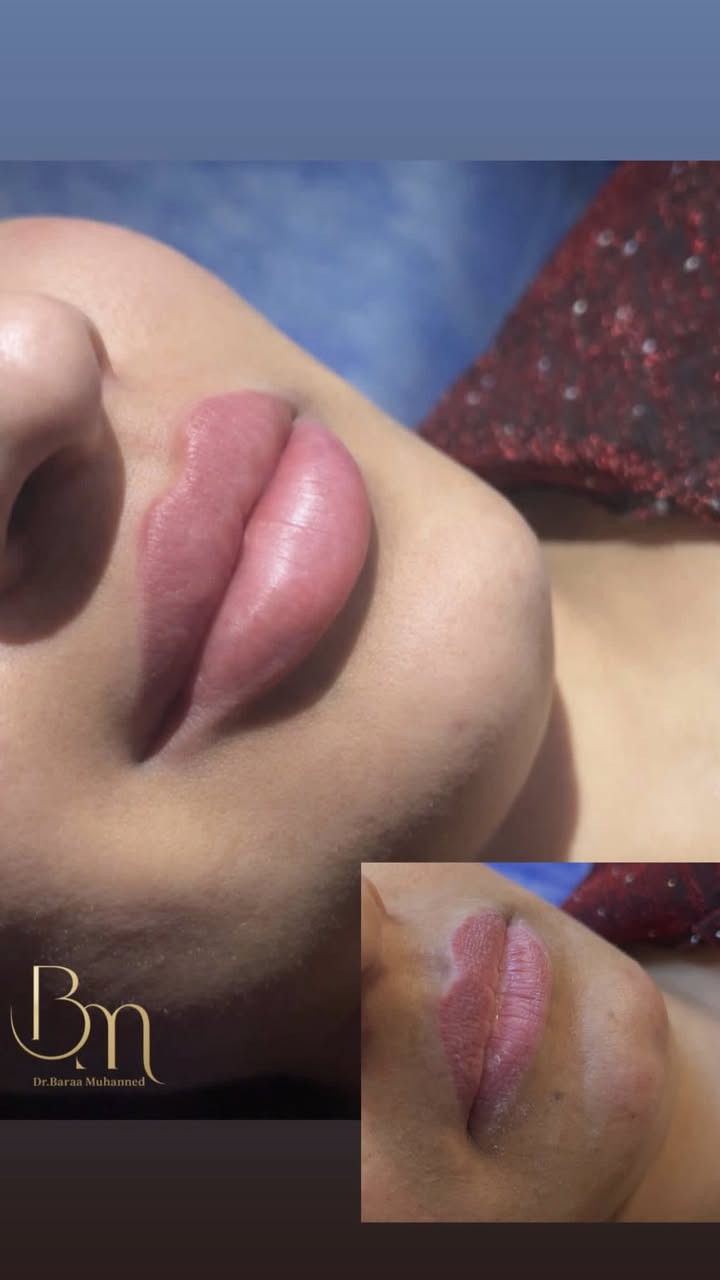 عيادة التجميل الاولى في الحسينية وتحت إشراف أطباء مختصين وبأنسب أسعار عنوان العيادة الجريخي مجمع الصدرين الطبي الطابق الثاني مقابل مطعم جكن اوسلو 
عيادة اوليفيا للتجميل 
للحجز والاستفسار واتساب ***********
