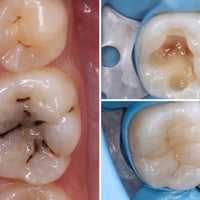 حشوات ضوئيه • ترميم سن كامل • اليمامه