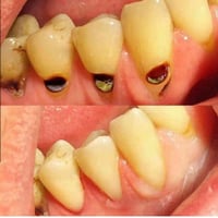 عيادات الجامعه الوطنيه • قلع اسنان • علاج مجاني