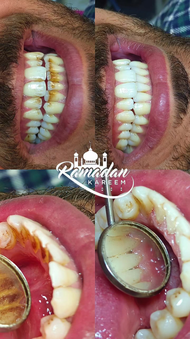 🌙 عيادة النور لطب الاسنان تهنئكم بحلول شهر رمضان المبارك،
نسأل الله أن يعيده عليكم بالصحة والعافية، وأن يمنّ عليكم بابتسامة مشرقة تدوم دائمًا.

كل عام وأنتم بخير 🌙

ويانه ابتسامتكم دوم مشرقة🦷🦷

حالة اليوم 🦷

ازالة ترسبات وتصبغات الاسنان 
⭕ د. آيات صبحي الجبوري
⚜ أيام التواجد: السبت | الأحد | الاثنين
⚡ وقت التواجد: 3:30 – 6:00 مساءً
🌐 العنوان: شارع الأطباء – مقابل صيدلية سعيد ابن الجبير
↩ للحجز والاستفسار: ***********
