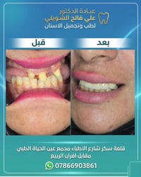تجميل أسنان • د. علي الشويلي • قلعة سكر