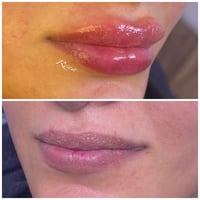 رينا • ليزر • تجميل