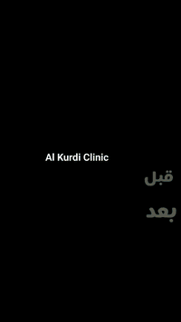 فرق واضح… ونتيجة تدوم ✨
من تساقط وفراغات إلى شعر كثيف ومظهر شبابي
اعتمد على خبرتنا وخلي التغيير يكون مضمون، لأننا نستخدم تقنيات عالمية حديثة مع كادر متخصص بزراعة الشعر يهتم بأدق التفاصيل.
✔️ فحص وتقييم شامل
✔️ زراعة شعر بدون جراحة
✔️ عناية طبية مستمرة
✔️ نتائج واقعية مثل اللي تشوفها
📞 احجز موعدك الآن:
***********
ست فرح واتساب
مجمع الكردي الطبي اختيارك الأفضل دائما 🫰😍
Al Kurdi Clinic
#زراعة_الشعر #قبل_وبعد #نتائج_مضمونة #كادر_مختص #تقنيات_زراعة_الشعر #ثقة #مظهر_جديد
