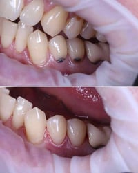 د. احمد عراك • تخفيضات اسنان • الحسينية بغداد