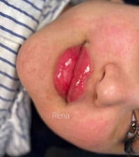 "شفاه ممتلئة وجذابة تعكس أنوثتك" فيلـــــــر  شـــــــــفة " 💋☘️  مع ر...