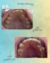 الفرق يبدأ من أول شهر مع اخصائية التقويم الدكتورة زهراء جاسم   مو لازم...
