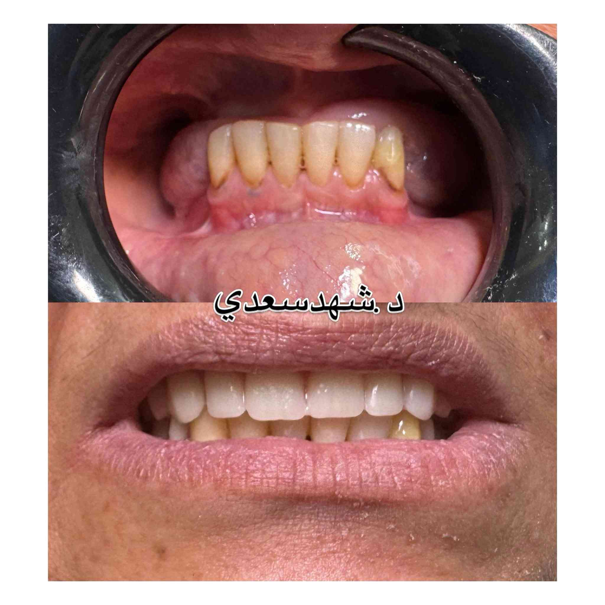 مرحبا بنوتات  شلونكم
وياكم د.شهدسعدي اخصائيه تقويم و سرتفكيت تجميل اسنان متواجدة بعيادة عياده الرحيق لطب وتجميل الاسنان قرب سوق علي نعمة السبت الاثنين الاربعاء صارلنا خمس سنوات والحمدلله مراجعينا يعرفون شون شغلنا نظيف و علمي و ننصح بالشي الزين و اسعارنا مناسبه 
رح اخليلكم صور من شغلي و اي استفسار عدكم تكدرون تتواصلون ويانه على الرقم *********** 
وهذا حسابي على الانستا 
https://www.instagram.com/drshahadsaadi618?igsh=Mjhkemhnbzdld3R5&utm_source=qr
