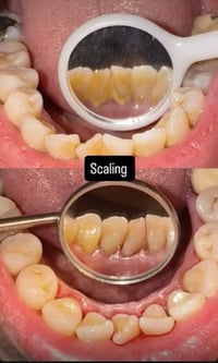 ✨ علاج أسنان مجانًا وبإشراف أطباء اختصاص ✨ السلام عليكم  • حشوات ضوئية...