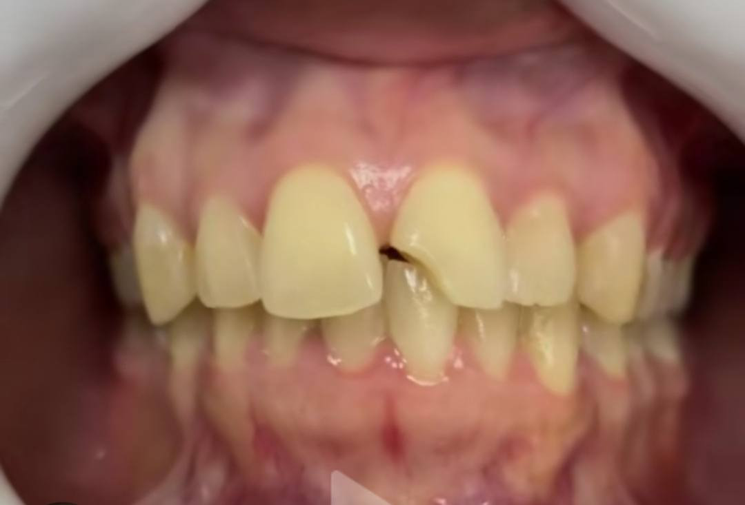 السلام عليكم ورحمه الله وبركاته
الي عندة تسوسات بأسنانه تشبه هاي الصور او كسر بلأسنان الامامية يراسلني على هذا الرقم واتساب ***********علما بأن العلاج مجاني وبأشراف دكاترة مختصين وبعيادات نظيفة تضمن راحة المريض
