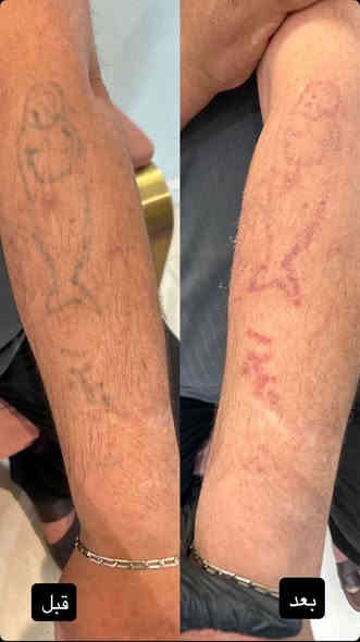 ازالة وشم من عياده سنايا
كربلاء - الجمعية
رقم الحجز ***********
