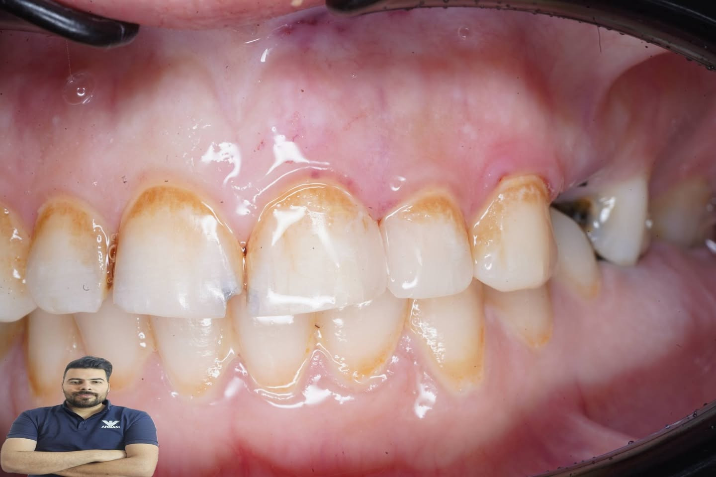 مراجعة عدهة تسوس بين الاسنان ومخرب شكلها سوينالهة حشوتين بحلسة واحدة ورجانة شكل الاسنان الطبيعي

العنوان /المسيب / شارع البلدية / مجاور عالم الحليب 

للحجز والاستفسار
***********
***********
