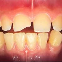 مجاناً،، منو عنده كسر بل سن الأمامي، حشوات تجميليه و اعادة السن الى شك...