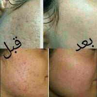 كربلاء • تصفية بشرة • نعومة