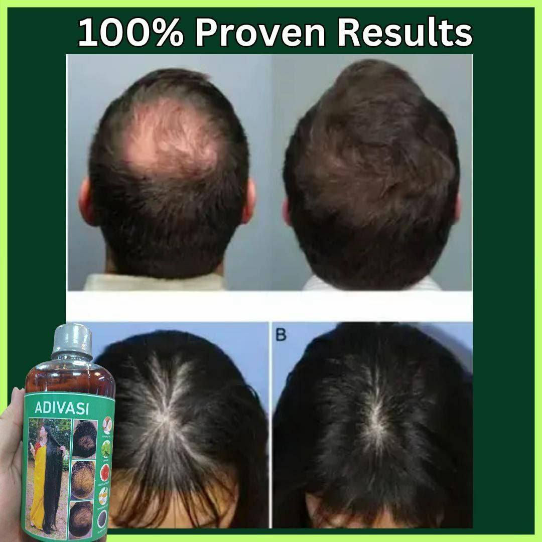 108 عشبة هندية.. يعني الحل الجذري لكل مشاكل الشعر! 🇮🇳✨
ليش زيت Adivasi مختلف عن أي زيت ثاني بالسوق؟
لأن تركيبته فريدة وتتكون من 108 عشبة طبيعية صافية! 🍃
يعني دتنطين شعرج فيتامينات ومعادن وعلاجات مكثفة بلمسة وحدة.
✅ يعالج الصلع الوراثي والتساقط الكربي.
✅ يثخن الشعرة ويمنع تكسرها.
✅ يطول الشعر بفترة قياسية.
✅ يرجع الحيوية للشعر التالف والمحروق.
دللي شعرج بخلاصة الطبيعة.. 💆‍♀️

صنع في الهند

#توصيل_كافة_المحافظات


**إذا كنت صاحب هذا الإعلان وتريد حذفه لأي سبب، رجاءا أرسل رسالة إلى الدعم الفني**