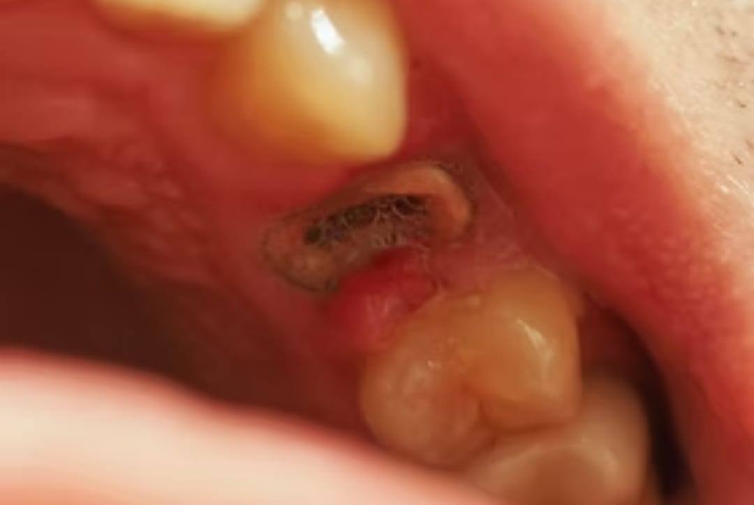 يتوفر علاج مجاني للاسنان في عيادات كلية دجلة في الدورة شارع المصافي يشمل حشوات ضوئية، ازالة التكلسات وتنظيف وتبييض الاسنان، قلع الاسنان والجذور المتبقية وتعويض الاسنان المفقودة باطقم جزئية متحركة
باشراف اطباء مختصين
للتواصل والحجز د. مريم فراس صاحب *********** يتم تعويض تكلفة المواصلات للمراجع عند الحضور
