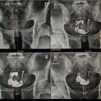 اليوم أحد المراجعات أجرت فحص الأشعة الملونة للرحم (HSG) في عيادتنا، وا...