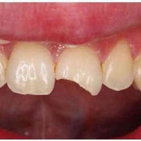 : اي شخص عنده مثل هيج حالات مال التسوس ومحتاج حشوات ضوئية يتواصل وياي ...