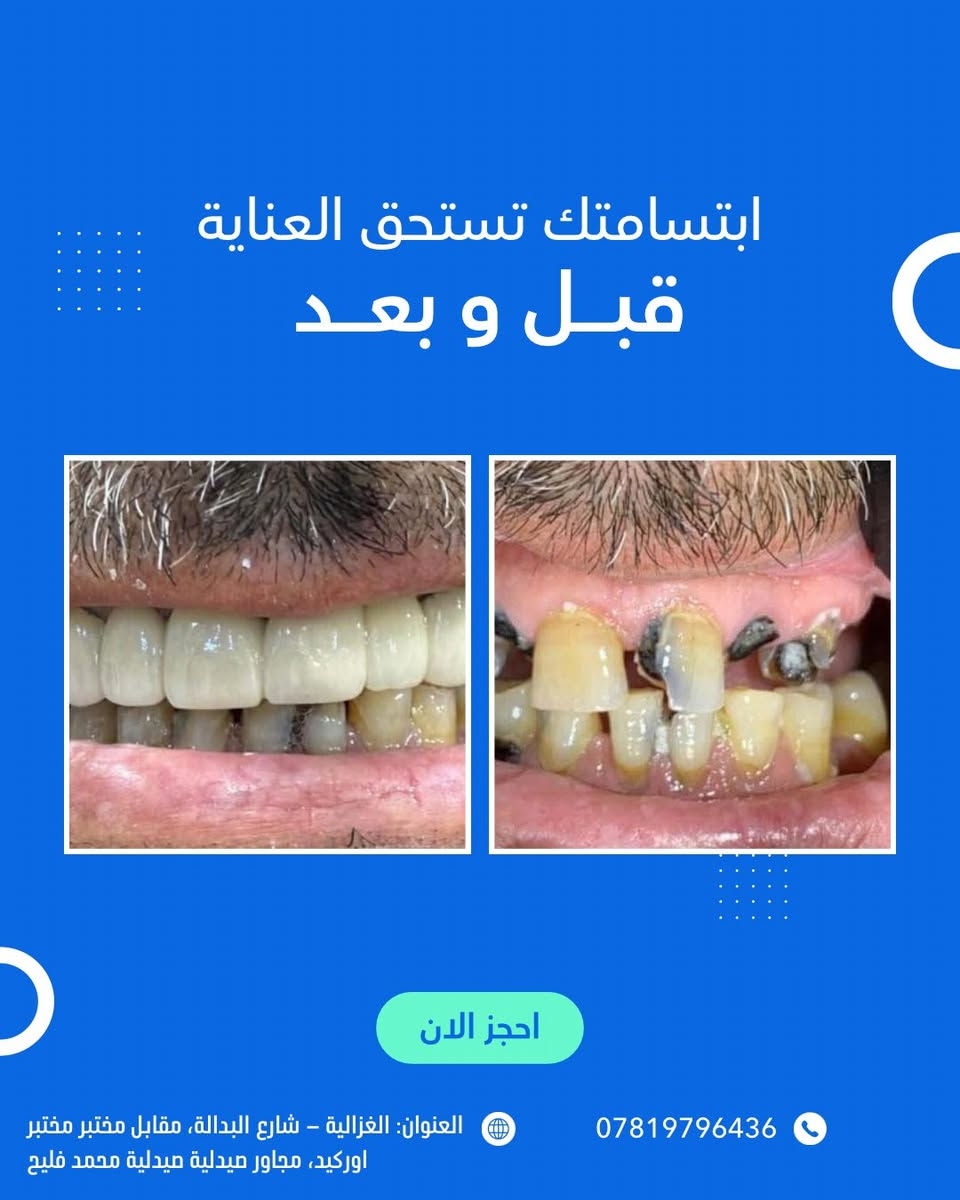 بشرى سارة 🌿

إلى أهالي الغزالية الكرام:

يسرّنا إعلامكم بـ اعلان عروض عيد الفطر المبارك في عيادة طب الأسنان التخصصية د.رسل رعد
 ونعلن عن تخفيض خاص بنسبة 50% ولمدة محدودة يشمل جميع الإجراءات العلاجية:

🔹 الحشوات التجميلية
🔹 حشوات الجذور
🔹 قلع الأسنان الاعتيادي والجراحي
🔹 تقويم الأسنان
🔹 زراعة الأسنان
🔹 تبييض وتنظيف الأسنان

✨ الفحص مجاني

💚تتوفر خدمة العلاج بالأقساط

📍 العنوان: الغزالية – شارع البدالة، مقابل مختبر مختبر اوركيد، مجاور صيدلية صيدلية محمد فليح
📞 هاتف العيادة: ***********
 0780 705 4413
🕓 أوقات الدوام في شهر رمضان المبارك بعد الافطار: من الساعة 7:00 مساءً ولغاية 11:00 مساءً

أهلاً وسهلاً بكم 🌸
صحتكم تهمّنا دائمًا
