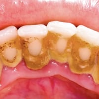 تنظيف تكلسات • مجاني • عيادات جامعة الهادي