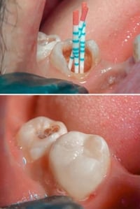 حشوه جذر • حشوه ضوئيه • مجمع اليمامه