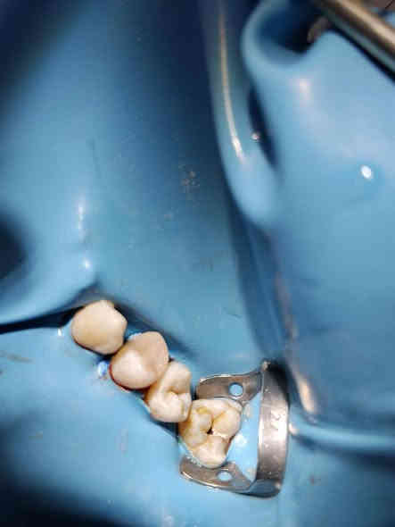 عمل حشوة جذر مع إعادة بناء...
العنوان(مسيب_تقاطع مسيب كربلاء_مجاور اعدادية السجاد)
للحجز والاستفسار 
***********
