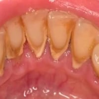 قلع اسنان • تنظيف اسنان • حشوات