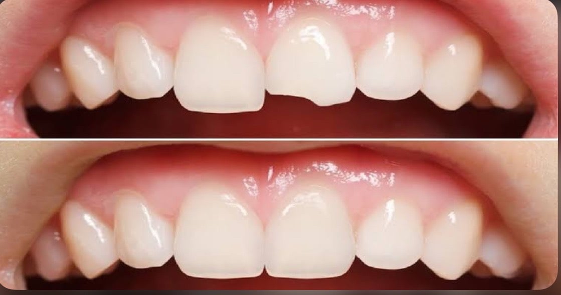  اي شخص محتاج حشوات اماميه او خلفيه او فاقد جميع اسنانه ويحب يعالج بشكل مجاني يتواصل وياي 
بغداد الاعظميه قريب مقبره ملكيه 