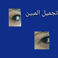 ازالة التجاعيد بتقنية الليزر للحجز والاستفسار اتصلوا برقم ٠٧٨١٧١١٥٨٣٢
